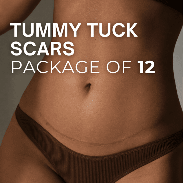 Tummy Tuck Scars (Package of 12) at TRUE HUE AESTHETICS in Beverly Hills, CA