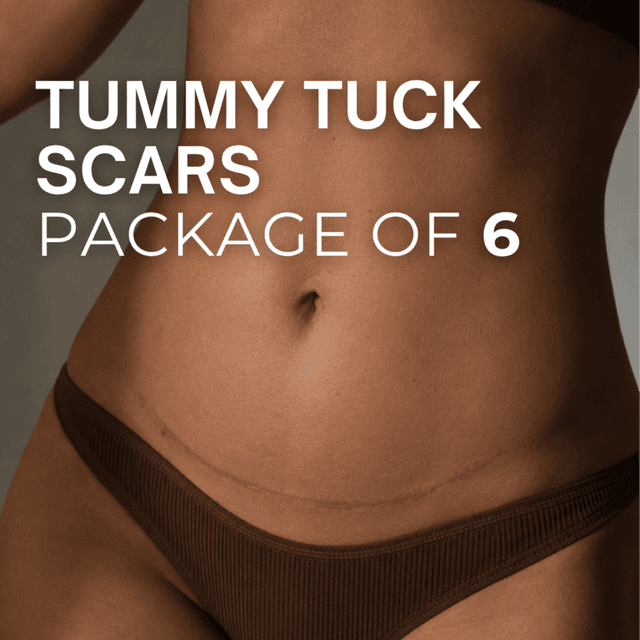 Tummy Tuck Scars (Package of 6) at TRUE HUE AESTHETICS in Beverly Hills, CA